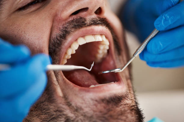 Best Emergency Dentist for Lost Fillings or Crowns in New Holstein, WI